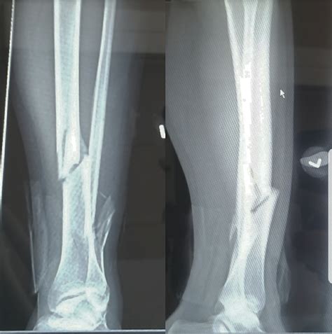 Compound tibia/fibula fracture : r/XRayPorn