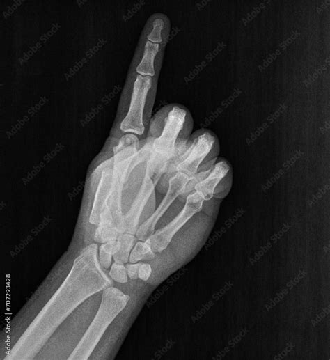 Film xray x-ray or radiograph of a hand and fingers showing the number one 1 in gestural ...