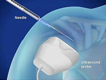 Ultrasound guided interventionals | Medscan Merrylands