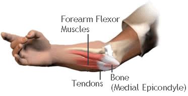 Corp Med - Tendonitis is inflammation of the tendons, particularly ...