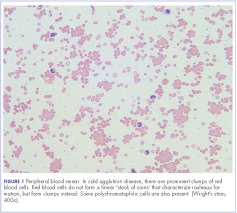 Cold hemolytic anemia: a rare complication of influenza A | MDedge Hematology and Oncology