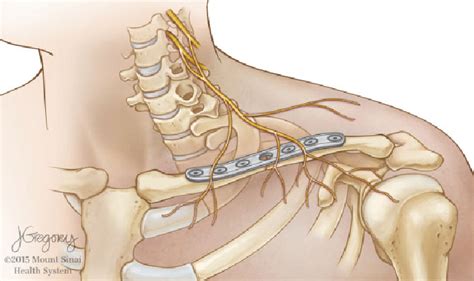 Supraclavicular Nerve Model