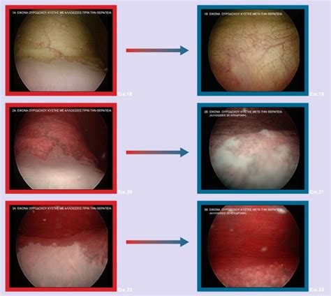 Chronic Cystitis Treatment and Therapy | Georgiadis Urology