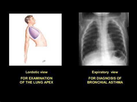 Basic chest x ray interpretation