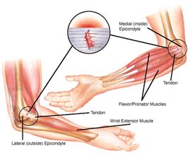 Differential Diagnosis - Elbow and Forearm