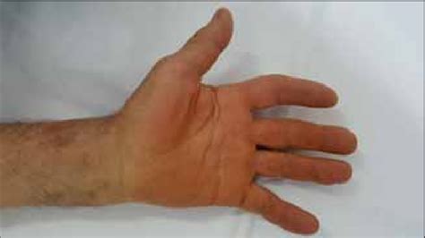 Palmar view of the same hand -Atrophy of thenar muscles with sparing of ...