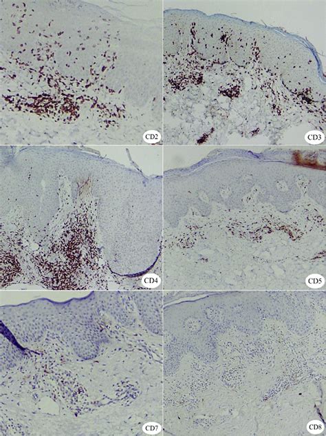 Immunohistochemistry showing positivity for CD2, CD3, CD4, CD5, CD7 and ...