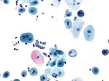 Atypical Urothelial Cells Indeterminate for Neoplasia - Urothelial Cells