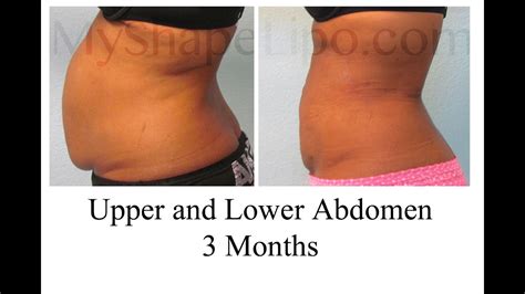 Mini tummy tuck and lipo - mtOlfe