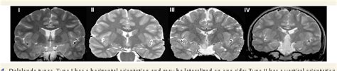 Gelastic Epilepsy | Semantic Scholar