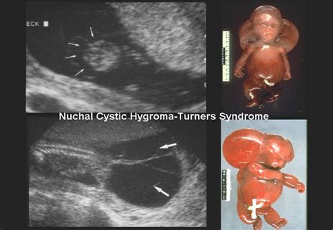 Complex Nuchal Mass