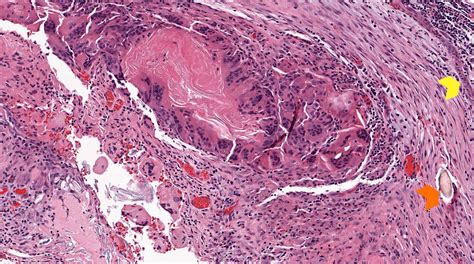 Cholesteatoma Histology