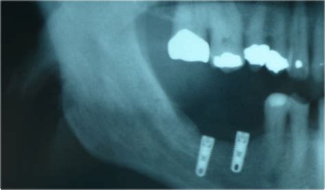 How to Manage Trigeminal Nerve Injuries in Dentistry - Dentistry Today