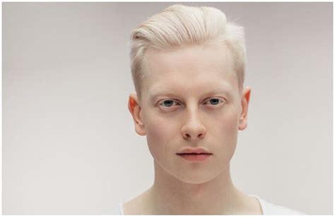 9 Famous People With Albinism - Your Health Remedy