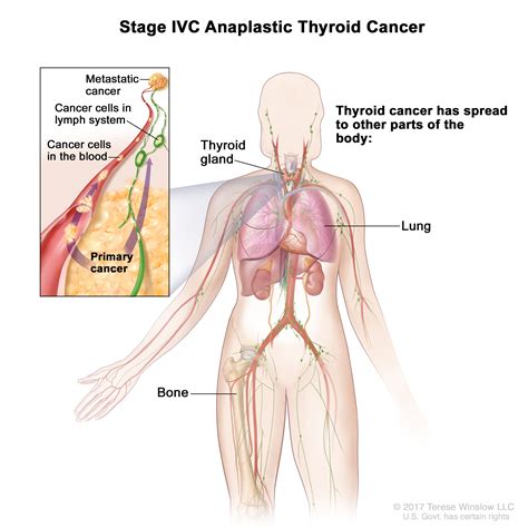 Thyroid Cancer Treatment (PDQ®)–Patient Version - NCI