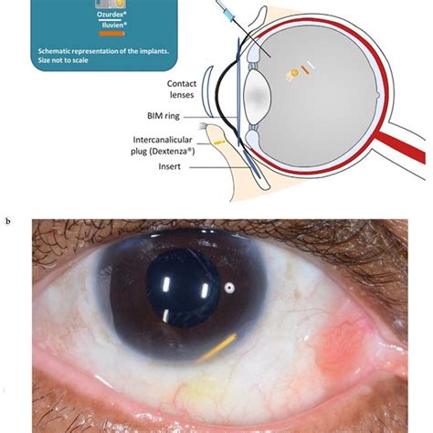 (a) Norplant rods' subcutaneous positioning in the implantation area of ...