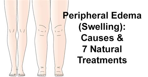 Peripheral Edema (Swelling): Causes & 7 Natural Treatments - David Avocado Wolfe