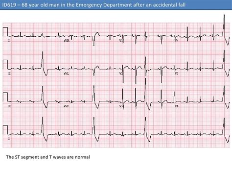 ECG #3 - ID 619 – Premature Ventricular Complexes