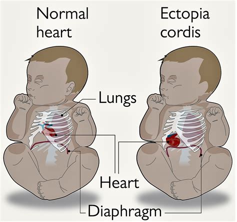 3rd Global Heart Congress: Ectopia Cordis - A Rare Heart Disease