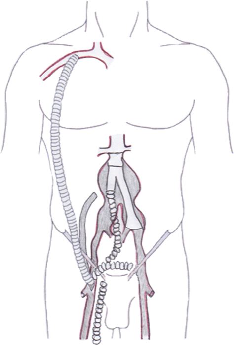 Iliac Remote Endarterectomy to Restore Circulation in a Patient with Infected Aorto-Femoral and ...