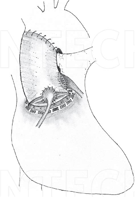 Modified Bentall procedure. | Download Scientific Diagram