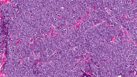 Pathology Outlines - Merkel cell carcinoma