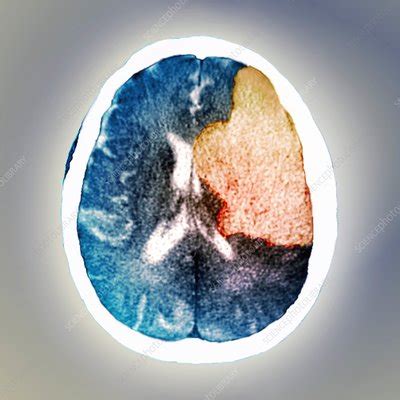 Brain in stroke, CT scan - Stock Image - C029/9807 - Science Photo Library