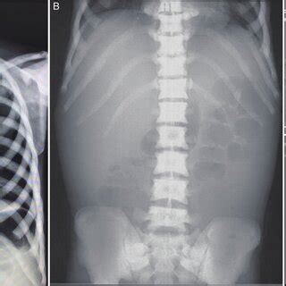 X-ray and computed tomography examination. (A) Typical radiograph of... | Download Scientific ...