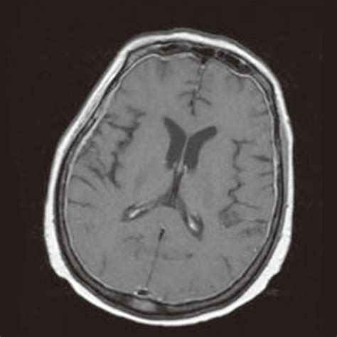 Brain MRI of the patient. Brain MRI shows no specific abnormalities ...