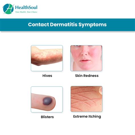 Irritant Contact Dermatitis Causes Pictures Symptoms