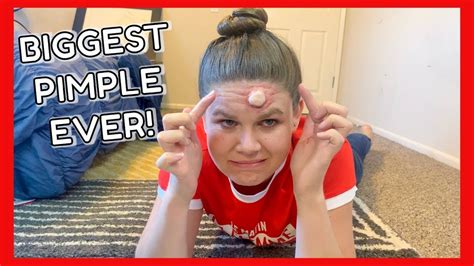 THE BIGGEST PIMPLE EVER! - YouTube