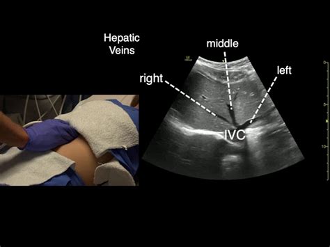 Liver Ultrasound Anatomy