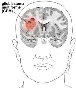 New treatment for Glioblastoma multiforme