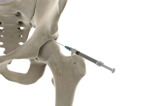 Intra-Articular Hip Injection | Excel Pain and Spine