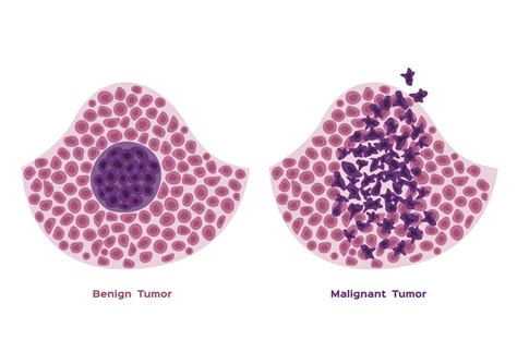 Benign vs. Malignant Tumors: What's the Difference?