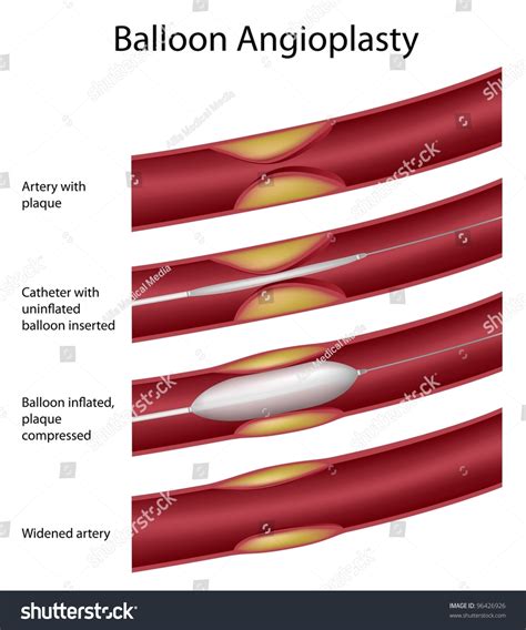 Balloon Angioplasty Procedure Stock Vector 96426926 - Shutterstock