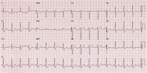 Brugada Syndrome • LITFL • ECG Library Diagnosis