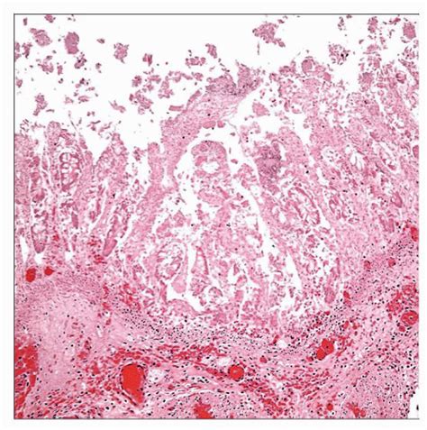 Necrotizing Enterocolitis Histology