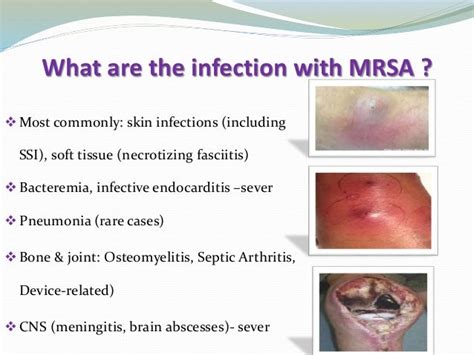 Understanding MRSA