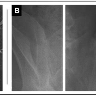 MRI diagnostic with active Sacroiliitis of the left Sacroiliac Joint of ...