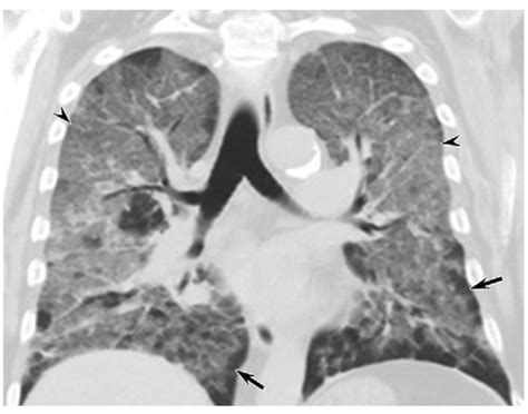 CT Scans Show Vaping-Related Lung Injury Patterns