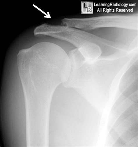 50k-shoulder injury: Learning Radiology- clavicle, clavicular ...