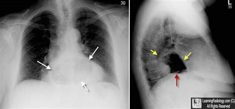 Learning Radiology - Giant Hiatal Hernia