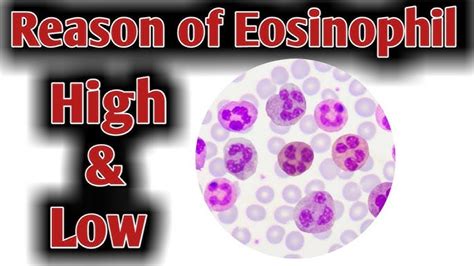 Low Eosinophils: Causes, Symptoms, and Treatment Options