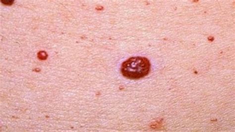 Red moles on skin: Causes and treatment options