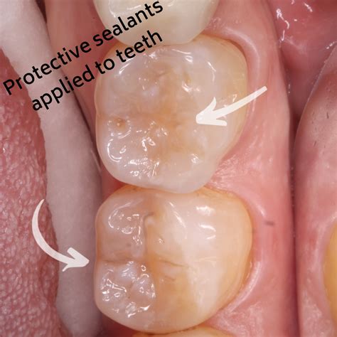 Fight Cavities with Sealants | Smile Gallery | Humble Dentist