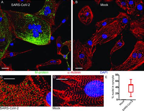 Cytopathic effects of SARS-CoV-2 in hiPSC-CMs. (A and B) IF confocal ...