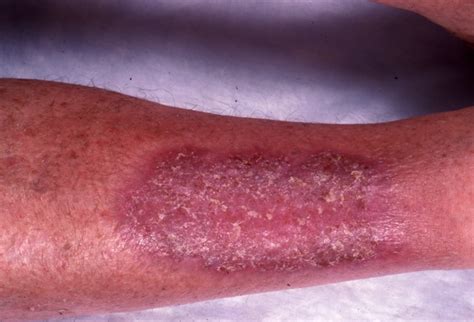 Acrodermatitis Continua of Hallopeau