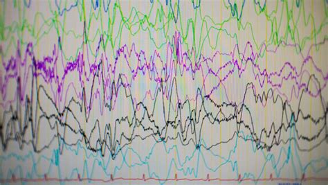 The Spectrum of Epilepsy