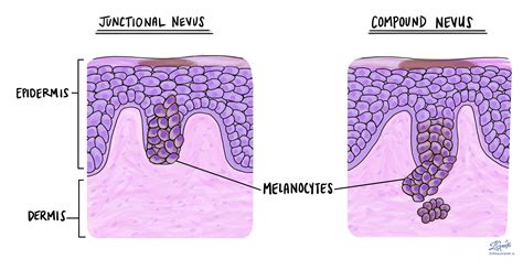 Compound Nevus Histology